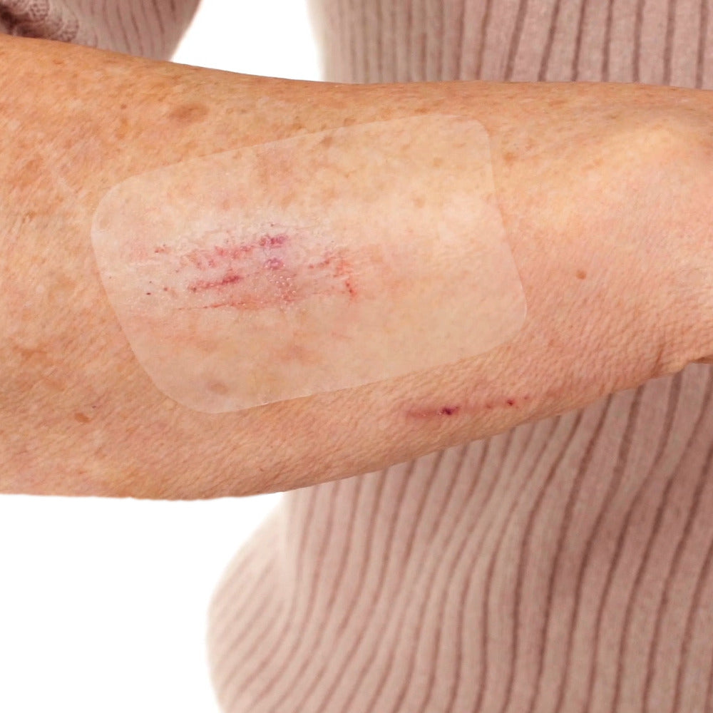 Leukomed T skin sensitive, steriler Transparentverband – im Einsatz